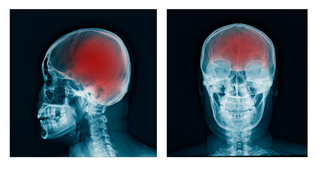 Traumatic Brain Injury (TBI) in Wyoming