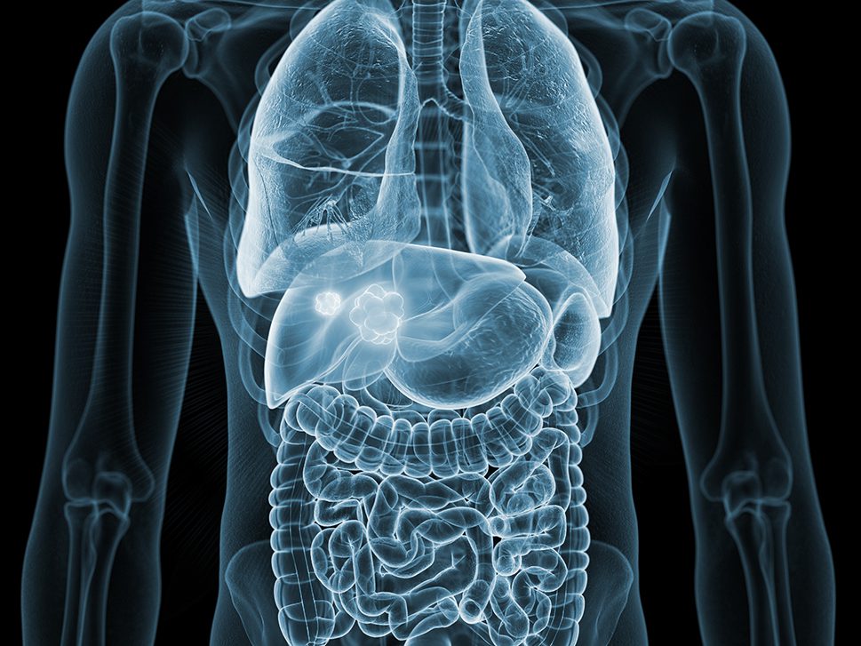 X-ray of upper body with illustration of liver cancer