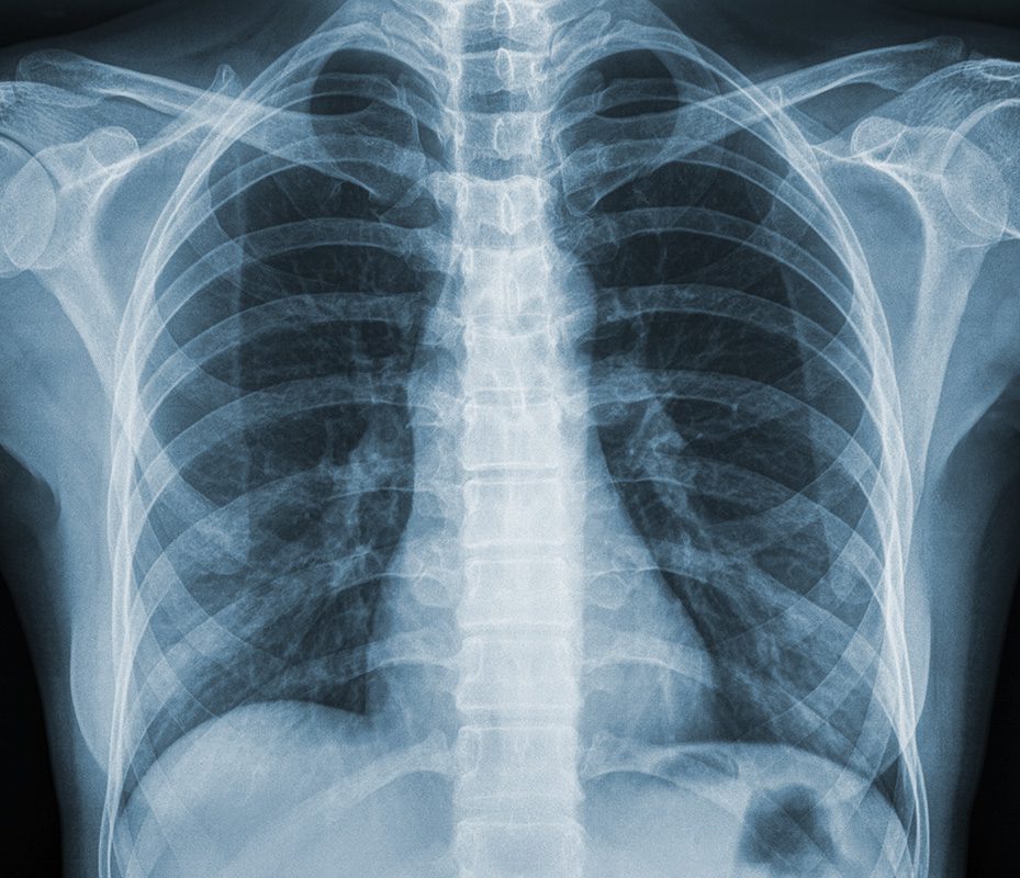 X-Ray of rib cage