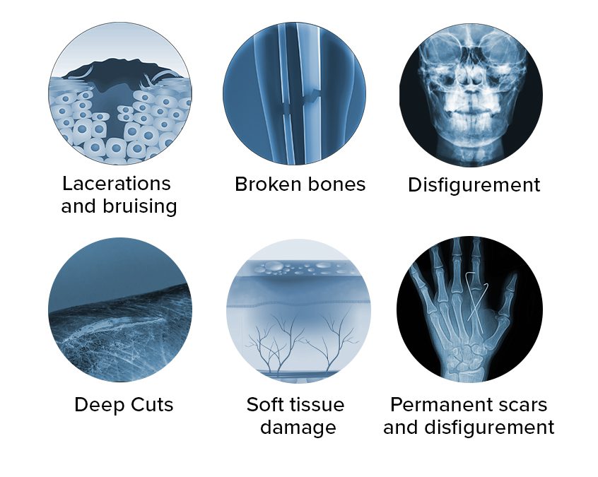 Common injuries from dog bites